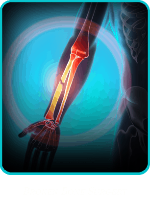 Broken Bone Surgery